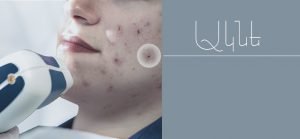 ակնեի բուժում