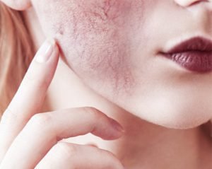 անոթային աստղիկներ