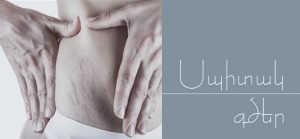 Սպիտակ բծեր