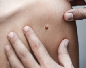 Կերատոմաների հեռացում