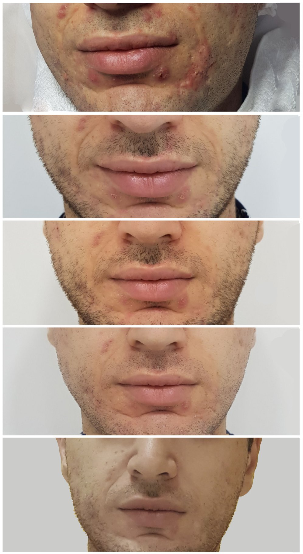 Acne - Cosmolab