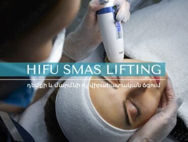HIFU 7Deep SMAS+ Õ´Õ¡Õ·Õ¯Õ« Õ±Õ£Õ¸Ö‚Õ´